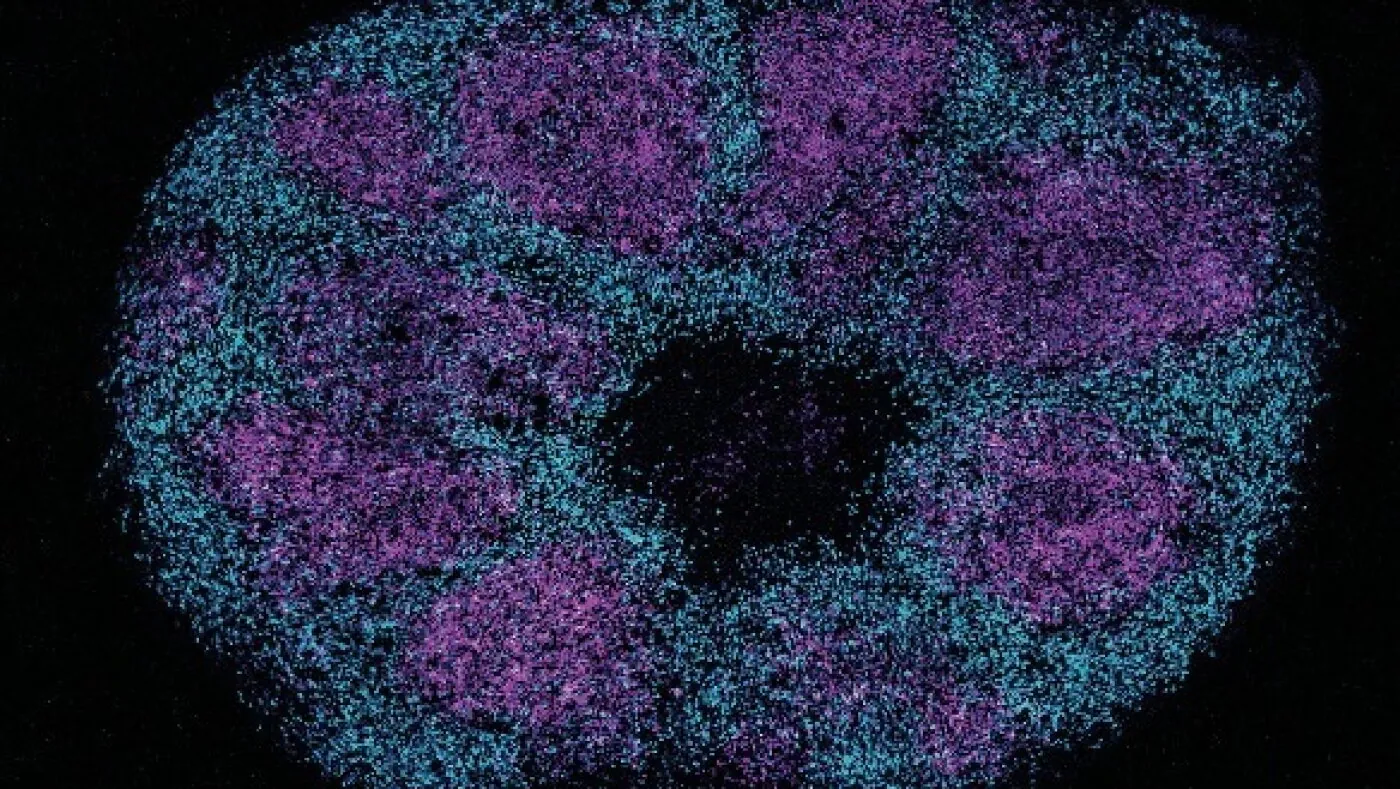 Scientists map key protein interactions linked with profound autism